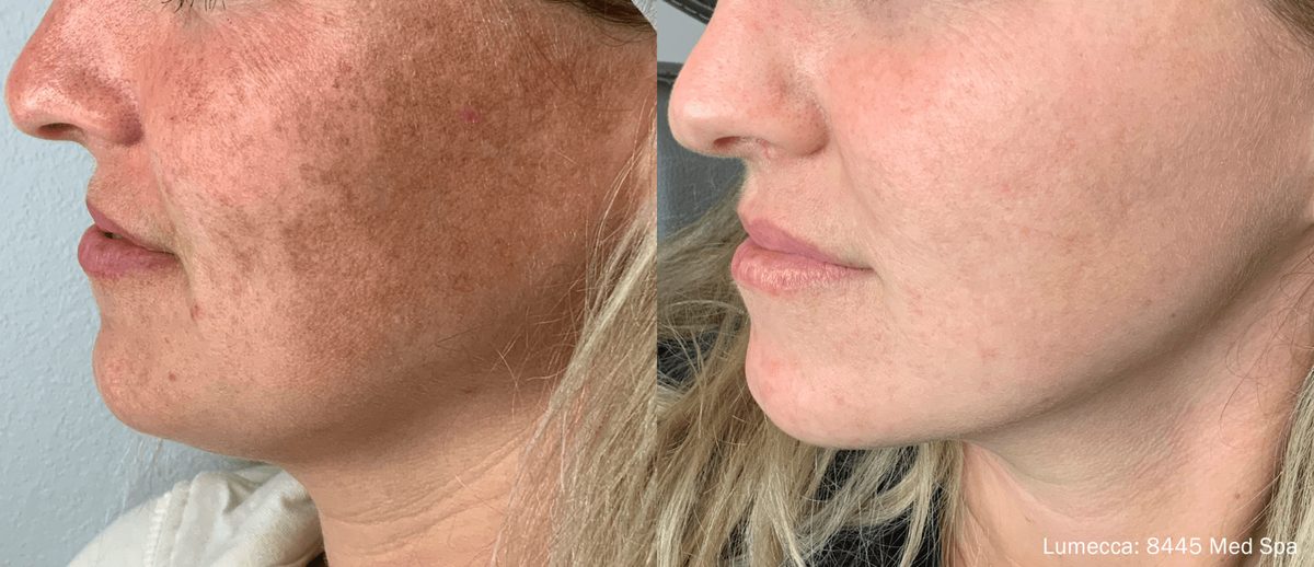 Lumecca IPL before and after, sun damage visibly reduced