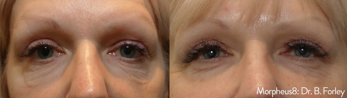 Morpheus8 before and after, reduced fine lines and improved texture