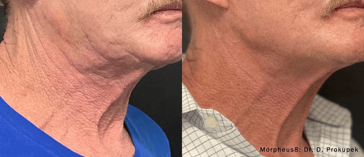 Morpheus8 before and after, firmer skin along the jaw and neck