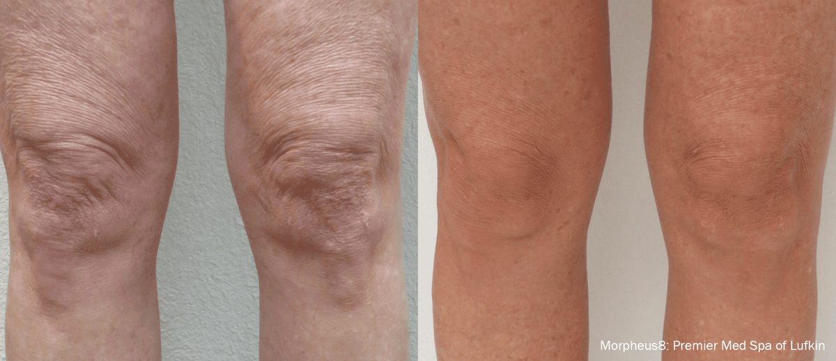 Morpheus8 before and after, smoother and tighter facial skin